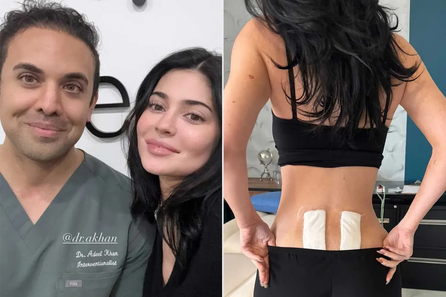 Kylie Jenner Shares Experience with Stem Cell Therapy for Chronic Back Pain Relief After Pregnancy