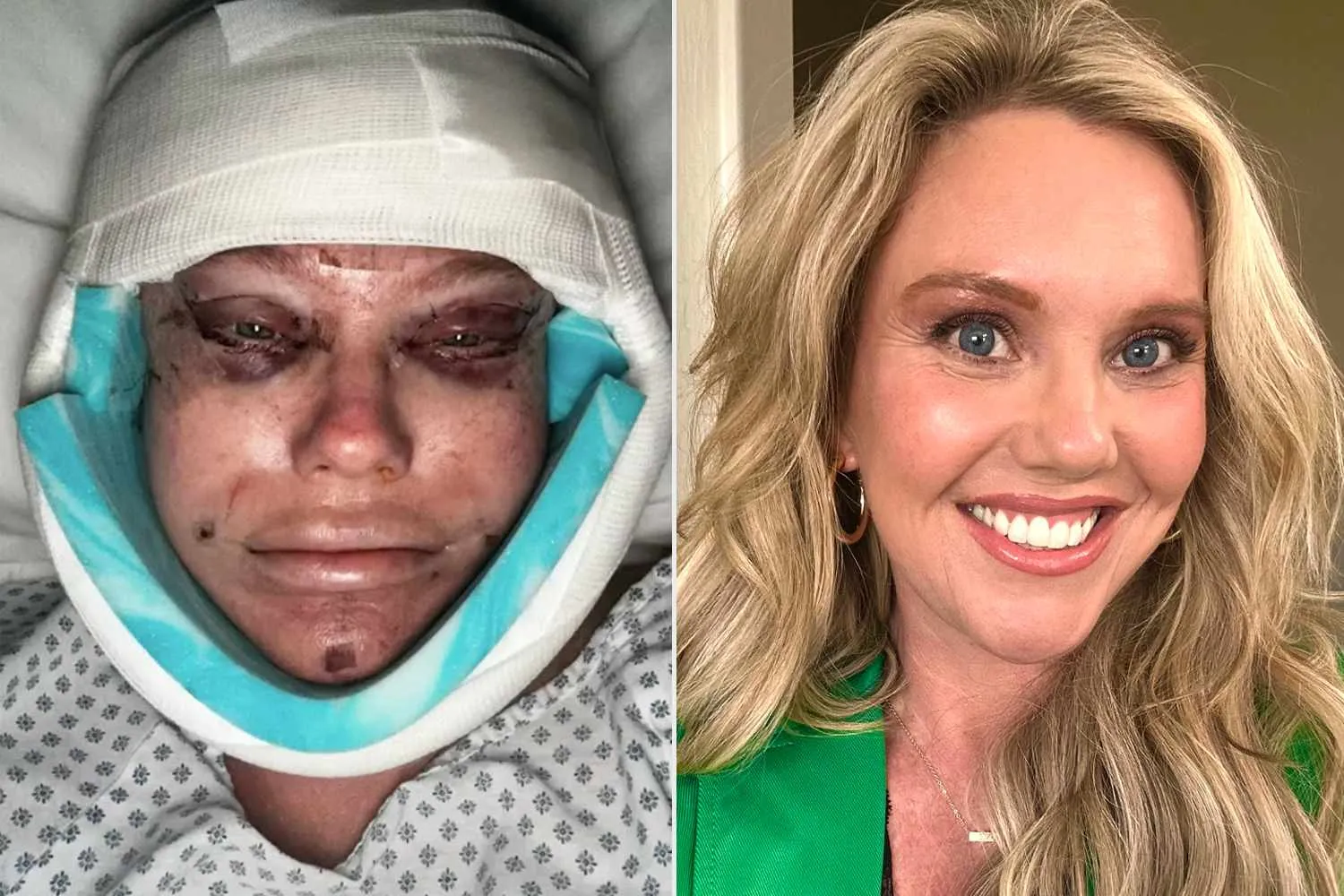 45-Year-Old Woman's Facelift Recovery Goes Viral: 'What Have I Done?'