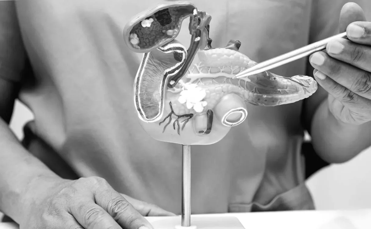 AI model for pancreatic cancer developed by Academia Sinica and NTU Hospital