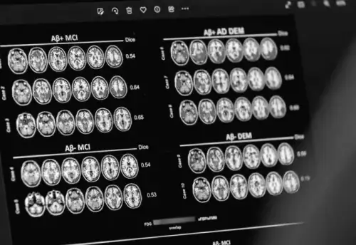 Study Finds: Protein linked to Parkinson's disease accelerates Alzheimer's progression in women
