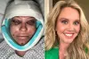 45-Year-Old Woman's Facelift Recovery Goes Viral: 'What Have I Done?'